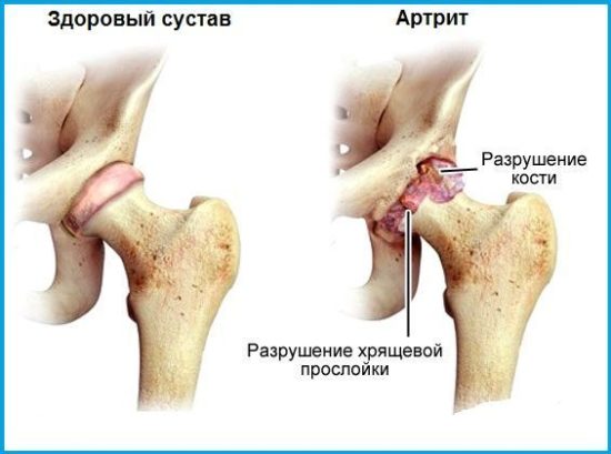 Серонегативный ревматоидный артрит