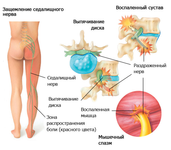 Межпозвоночная грыжа поясничного отдела