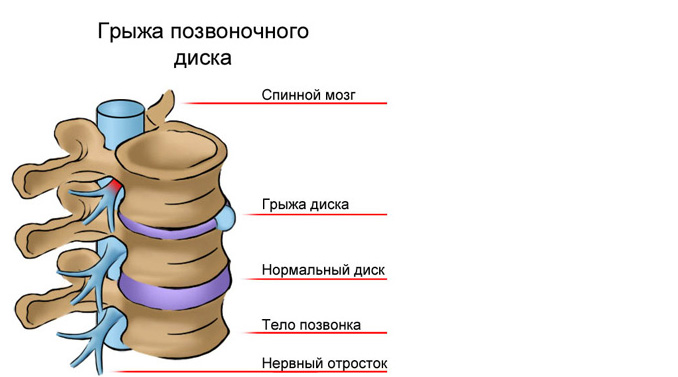 Межпозвоночная грыжа поясничного отдела