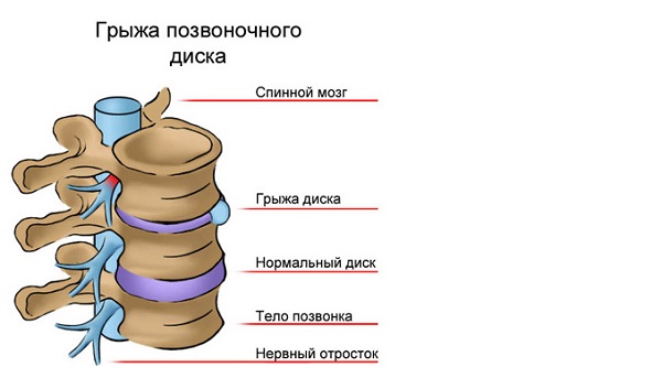 Лечить грыжу позвоночника
