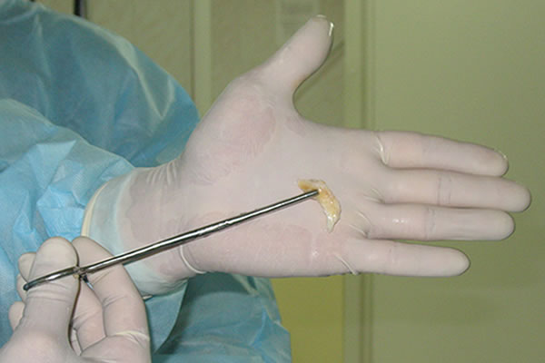 Артроскопия мениска: удаленный из колена хрящ Резекция мениска: удаленный из колена хрящ