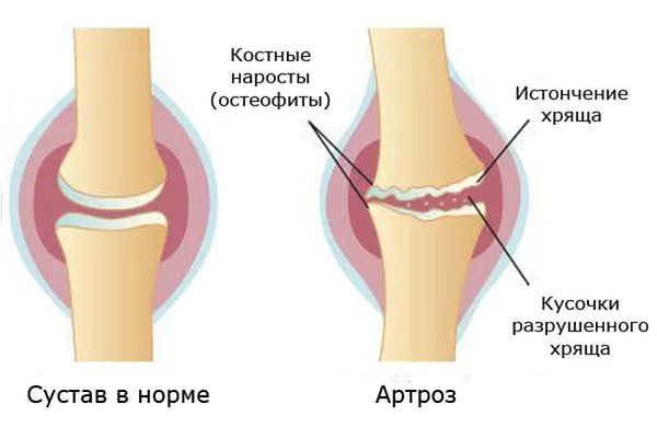 Деформирующий артроз