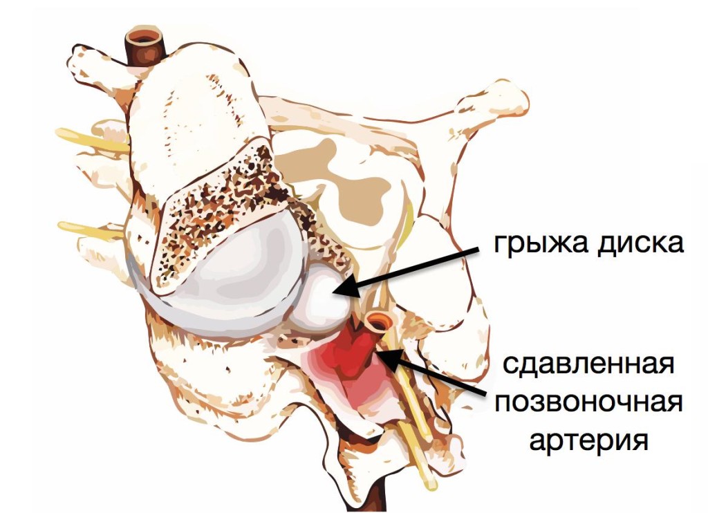 Методы лечения спондилоартроза шейного отдела Спондилоартроз шейного отдела