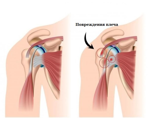Болит плечо левой руки: причины Болит плечо левой руки