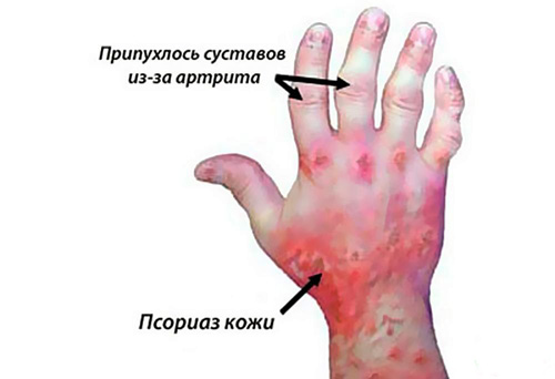Инфекционно-аллергический артрит