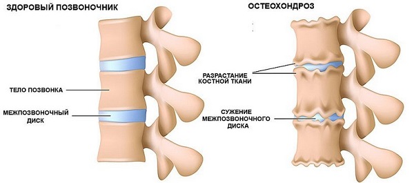 Лечение шейного остеохондроза