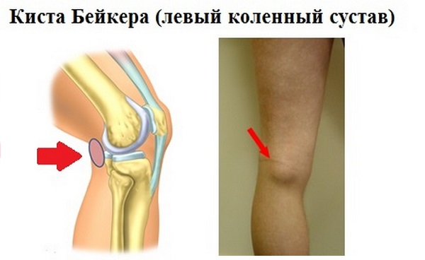 Киста Бейкера коленного сустава