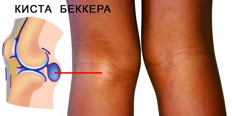Опухоль под коленом