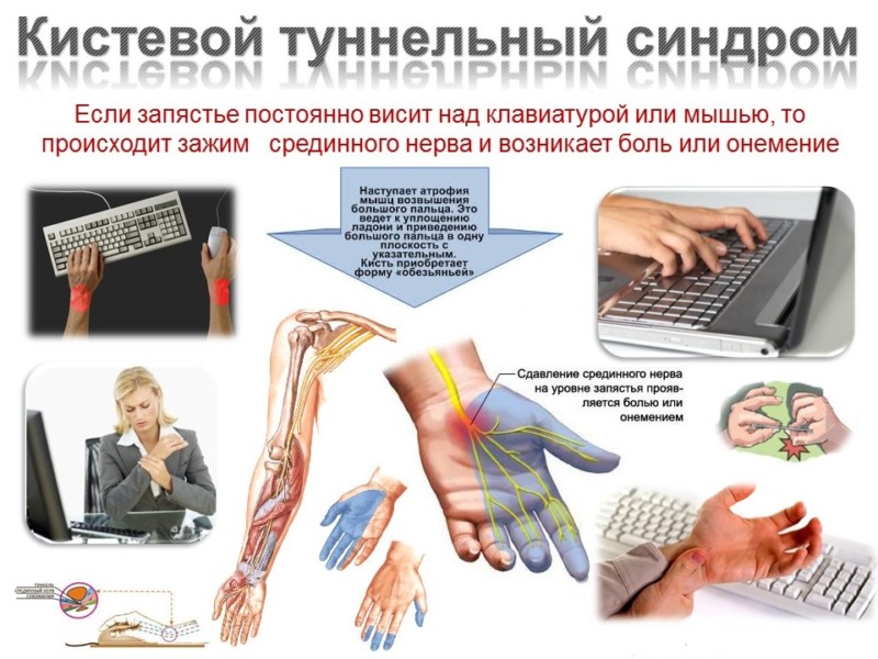 Причины туннельного синдрома запястья