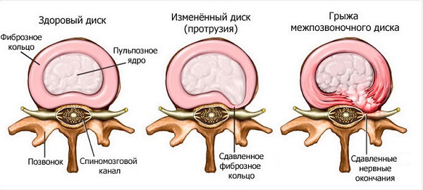 Лечить грыжу позвоночника