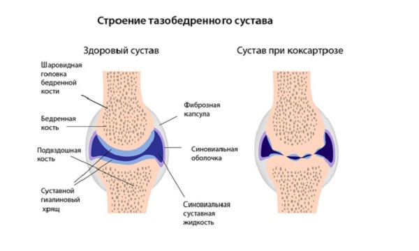 Лечение коксартроза