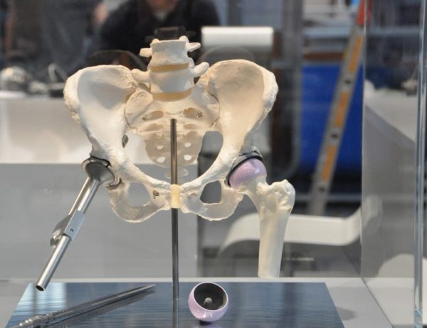 Операция на тазобедренный сустав: артродез Операция на тазобедренный сустав