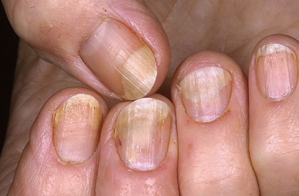 Симптомы псориатического артрита Псориатический артрит