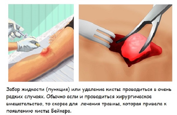 Киста Бейкера коленного сустава