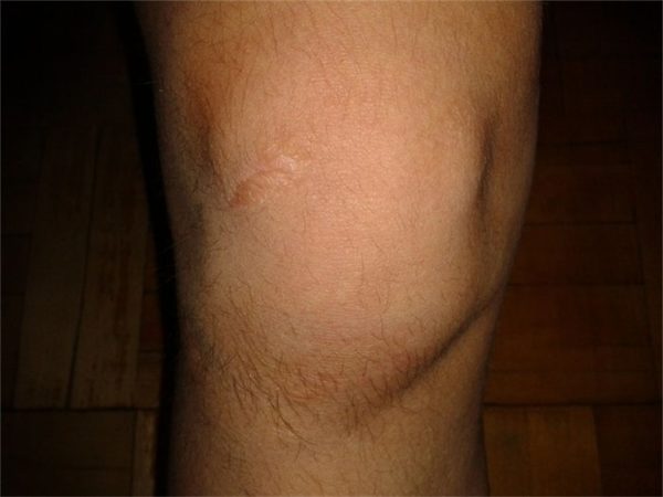 Опухло колено: причины Опухло колено