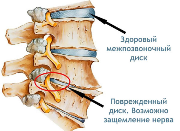 Радикулит поясничный