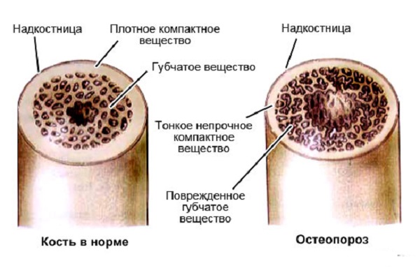 Остеопороз