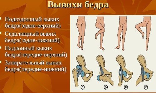 Боль в тазобедренном суставе отдает в ногу