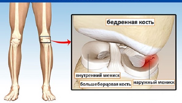 Мениск коленного сустава