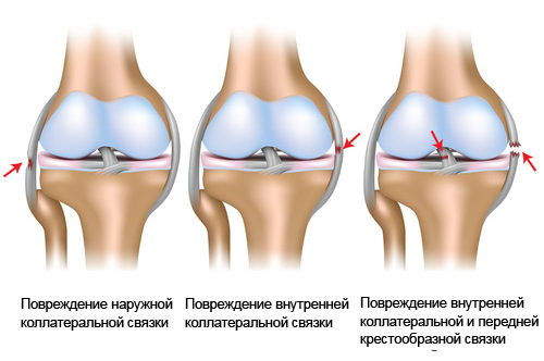 Разрыв связок коленного сустава
