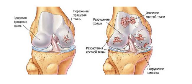 Боль в коленном суставе