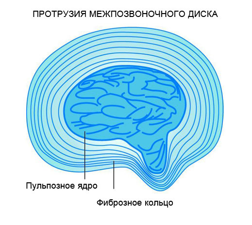 Особенности протрузии поясничного отдела Протрузия поясничного отдела