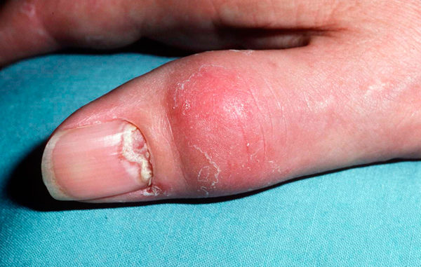 Причины возникновения псориатического артрита Псориатический артрит