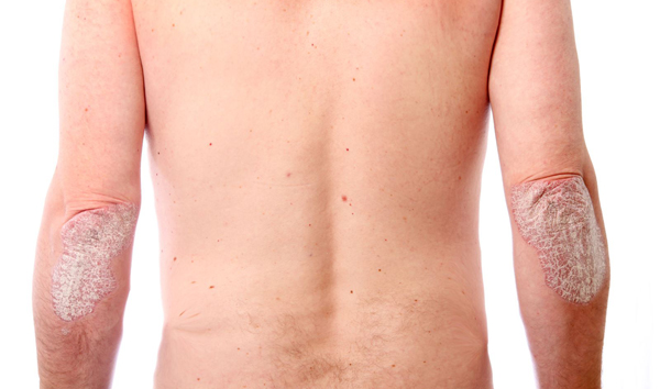 Виды псориатического артрита Псориатический артрит