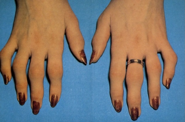 Методы лечения псориатического артрита Псориатический артрит