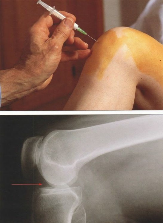 Синовит коленного сустава: пункция Синовит коленного сустава