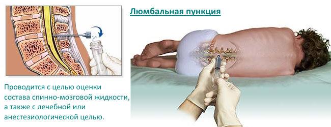 Пункция спинного мозга