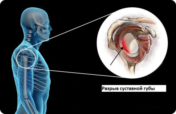 Разрыв суставной сумки