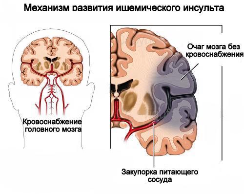 Деформирующий спондилез шейного отдела