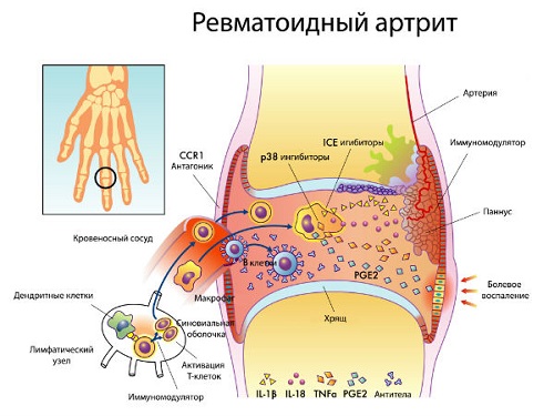 Боли в суставах рук и ног при ревматоидном артрите Боли в суставах рук и ног