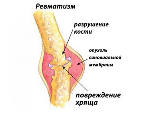 Ревматизм у детей
