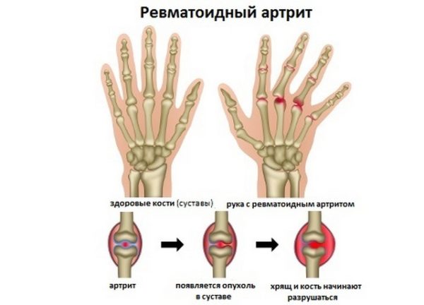 Боли в суставах пальцев рук