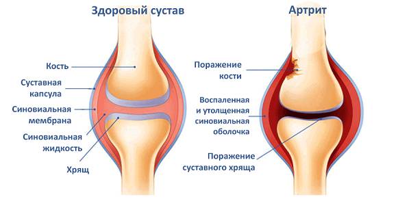 Ревматоидный артрит
