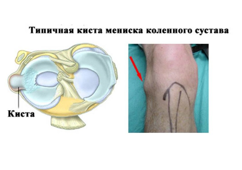 Опухоль под коленом