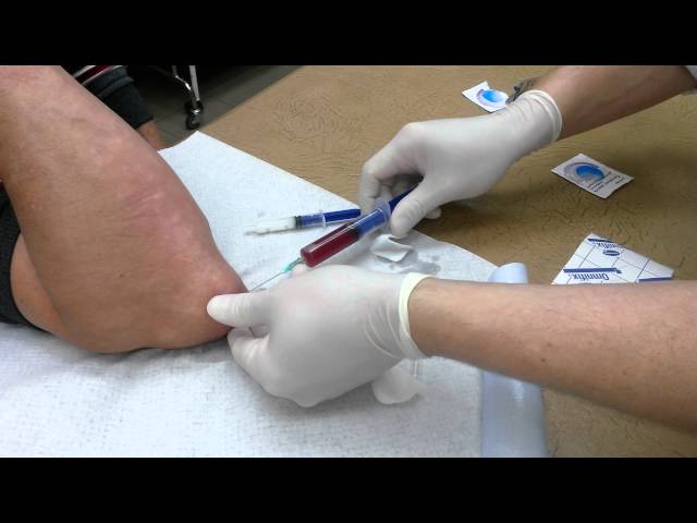 Шишка на локтевом суставе: пункция Шишка на локте: пункция