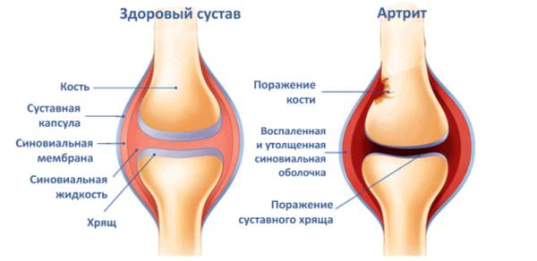 Болят колени при вставании из-за артрита