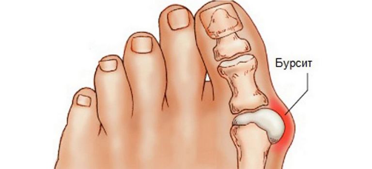 Шишки на суставах пальцев ног при бурсите Шишки на суставах пальцев ног