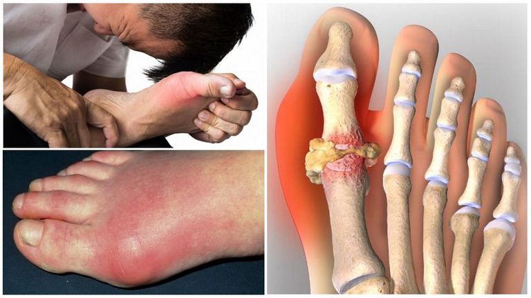 Шишки на суставах пальцев ног при подагре Шишки на суставах пальцев ног