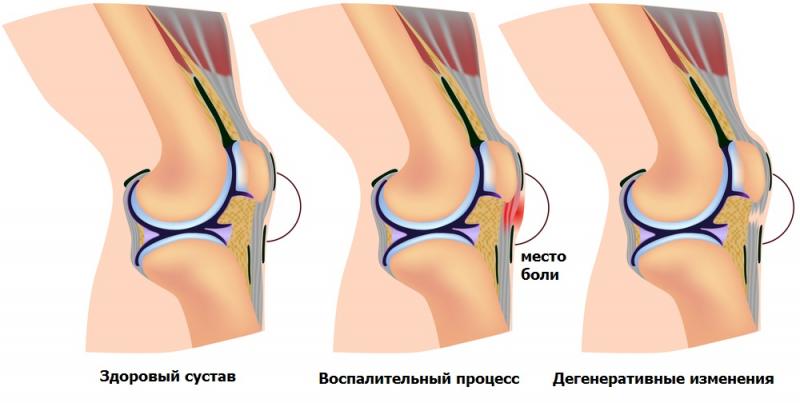Пателлофеморальный артроз