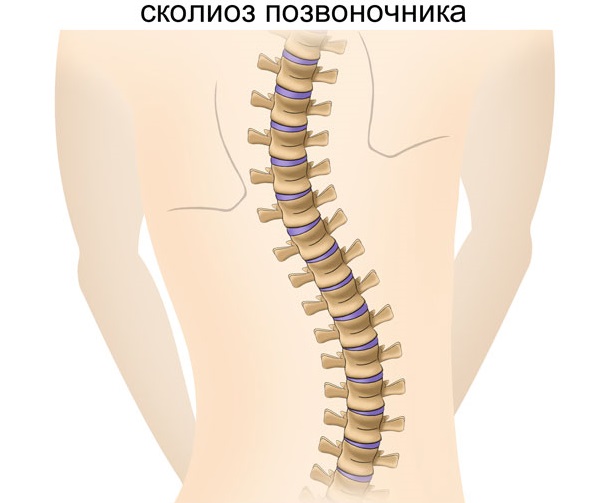 Лечение сколиоза позвоночника