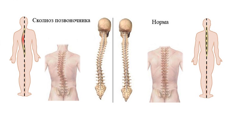 Лечение сколиоза позвоночника