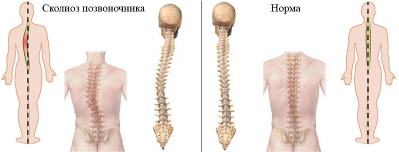 Сколиоз позвоночника