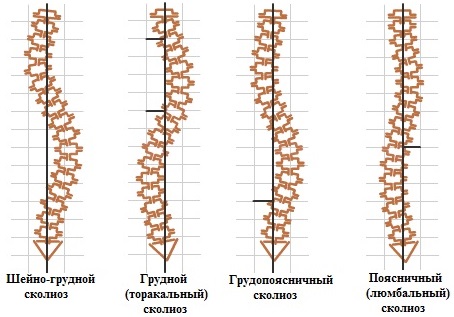 Сколиоз позвоночника