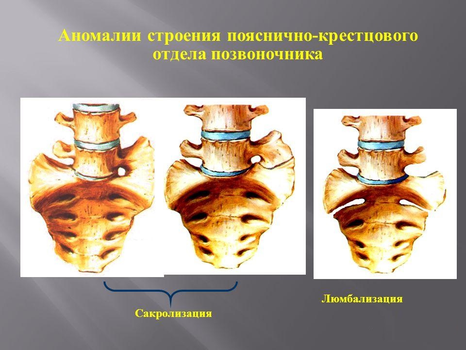 Аномалии строения пояснично-крестцового отдела позвоночника