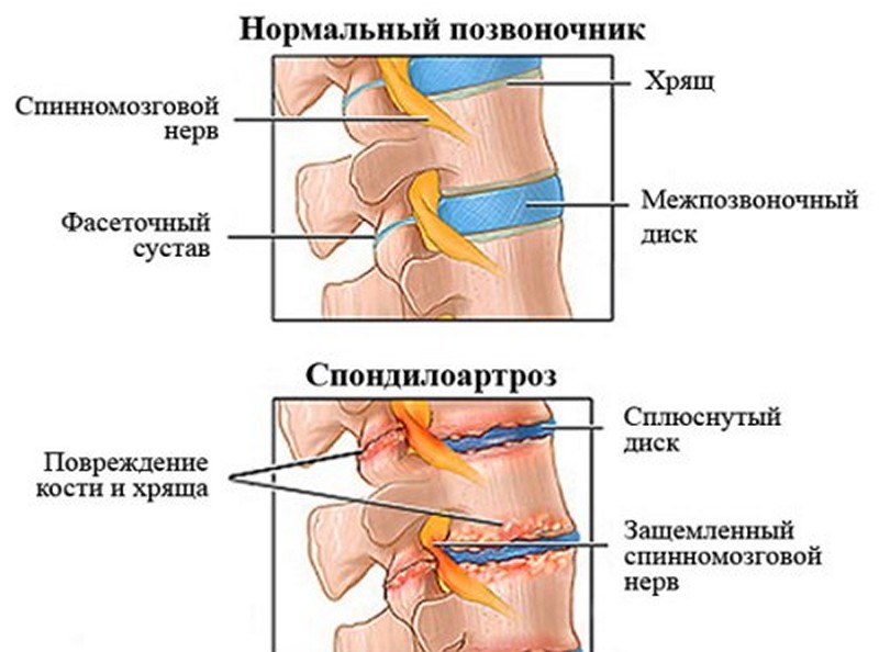 Особенности спондилоартроза шейного отдела Спондилоартроз шейного отдела