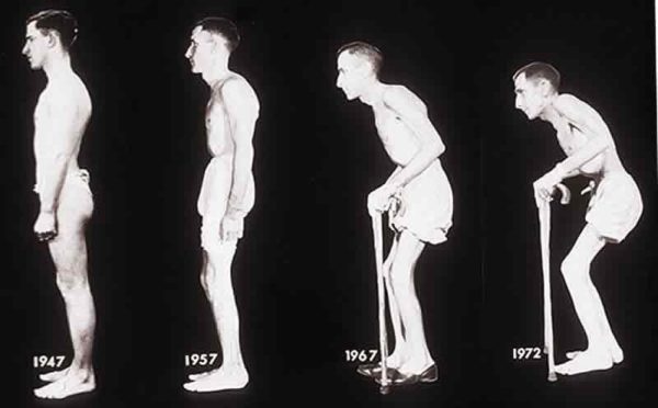Развитие анкилозирующего спондилоартрита Анкилозирующий спондилоартрит